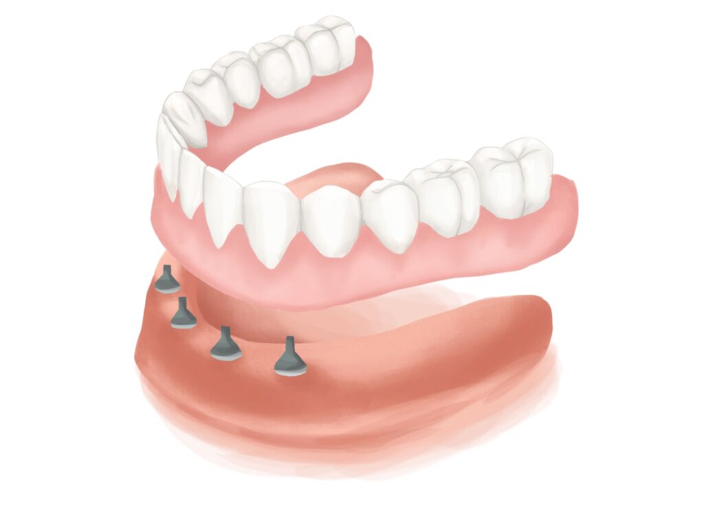 all-on-4-dental-implants-clear-gums-technical-picture_50730895461_o