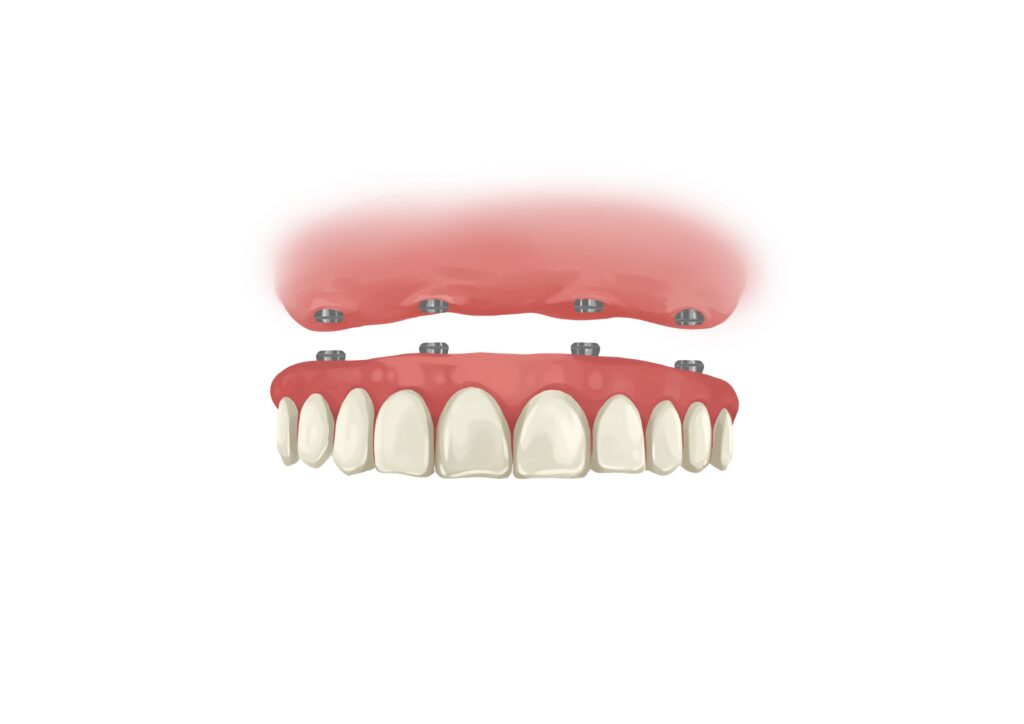 all-on-4-dental-implants-upper-arch-technical-picture_50730895401_o