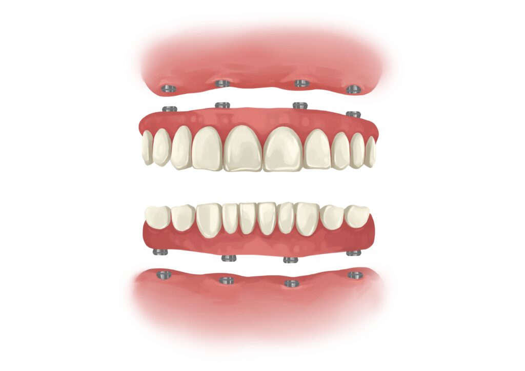 all-on-four-dental-implant-both-arches-technical-picture_50730895396_o