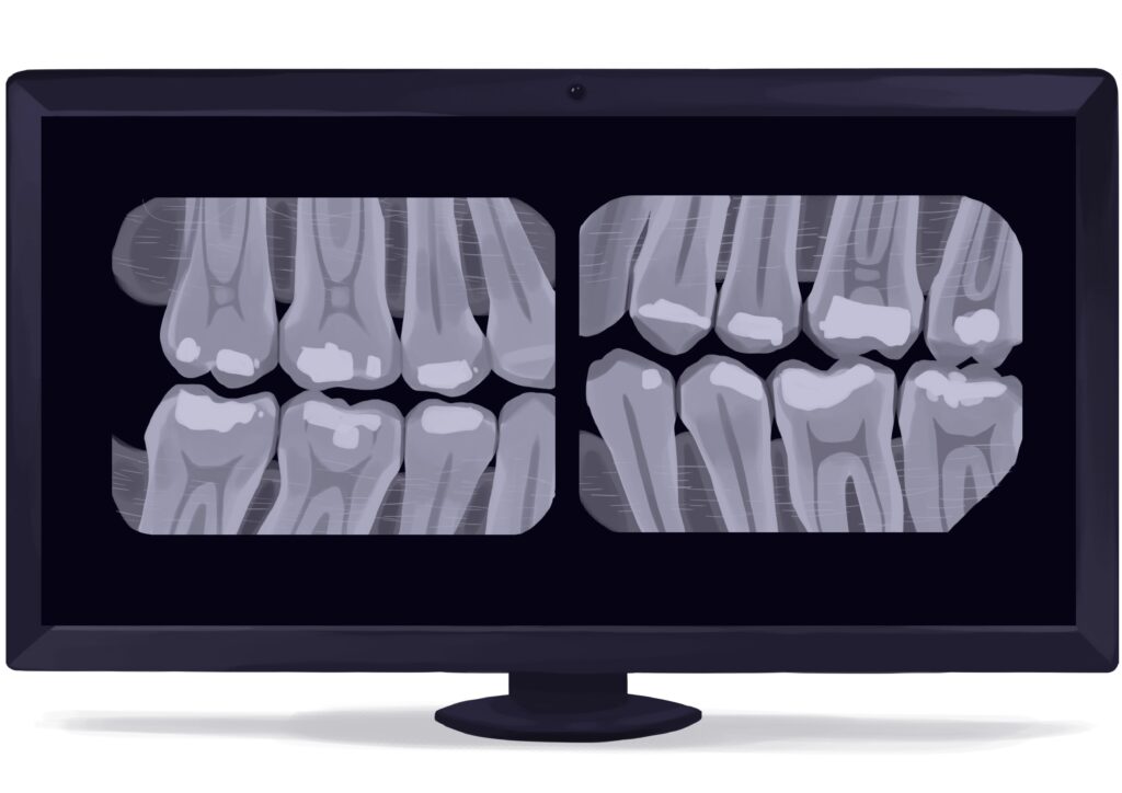 bitewing-dental-x-ray-digital-technical-picture_50776264468_o