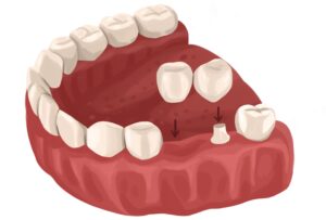 cantilever-dental-bridge-technical-picture_51262198955_o