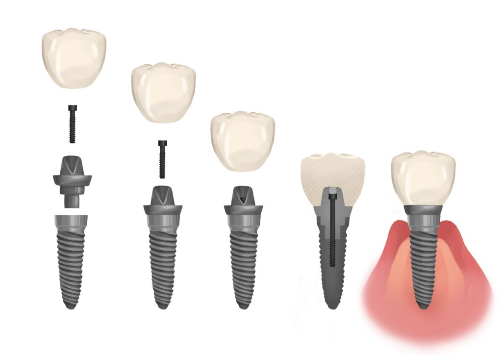 dental-implant-in-parts-technical-picture_50730991152_o