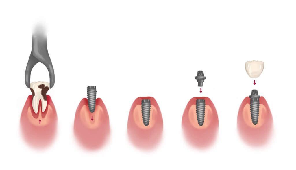 dental-implant-process-steps-technical-picture_50730166218_o