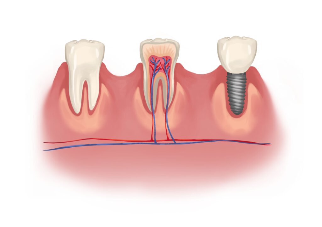 dental-implant-vs-natural-tooth-with-nerves-technical-picture_50730990802_o