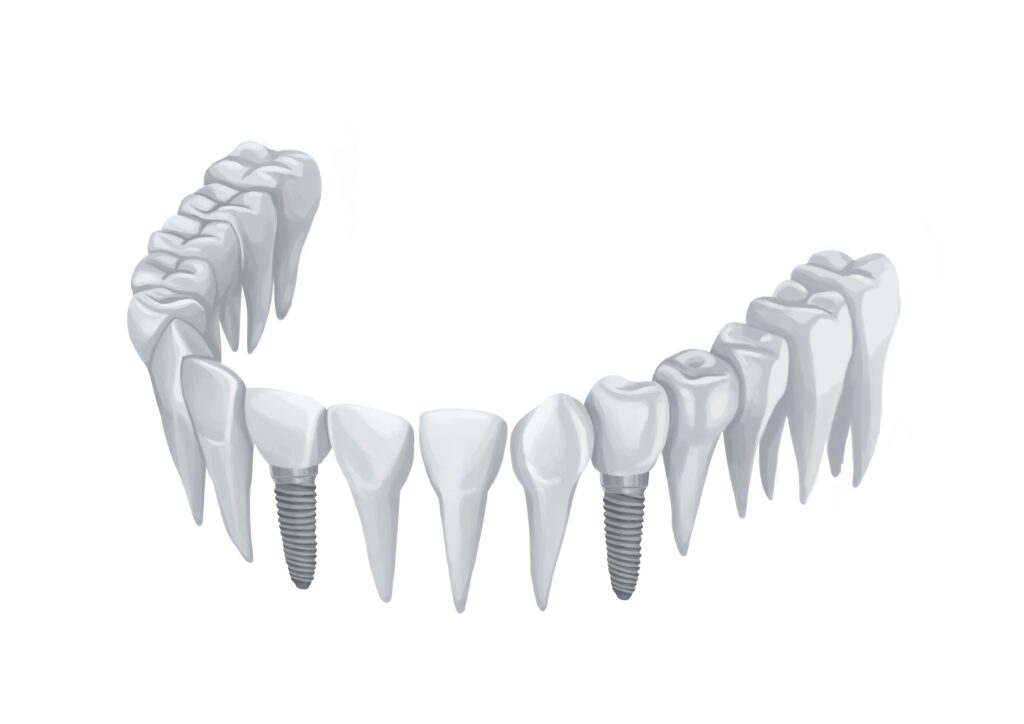 dental-implants-on-lower-arch-without-gums-technical-picture_50730166193_o