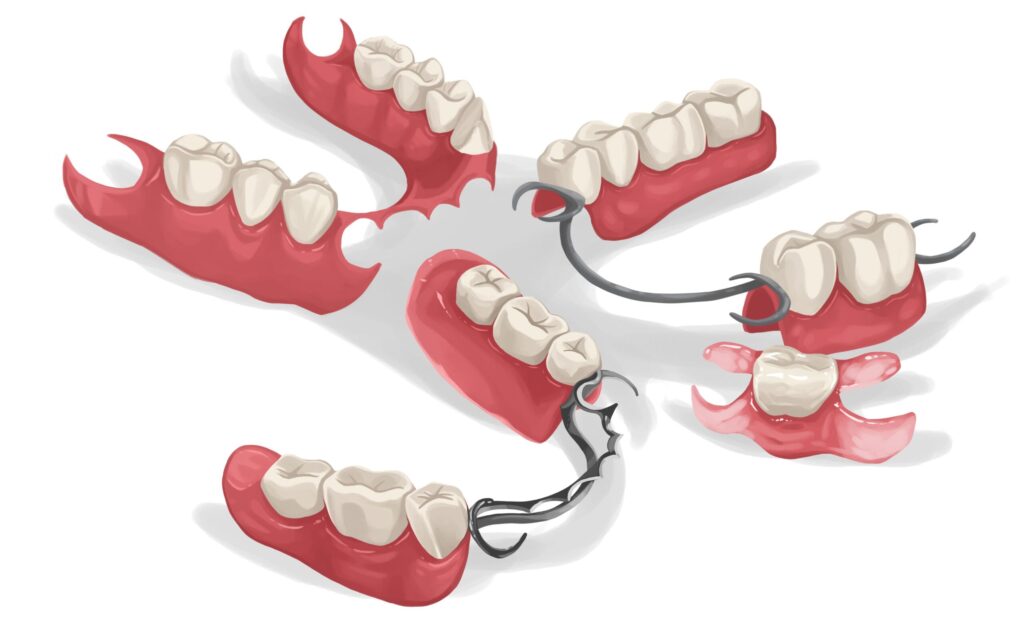 different-types-of-partial-dentures-technical-picture_50729828267_o