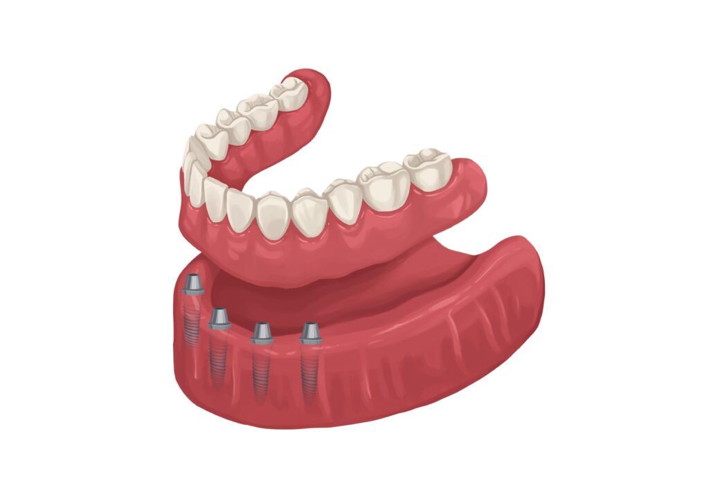 fixed-implants-denture-lower-arch-technical-picture_50730166303_o