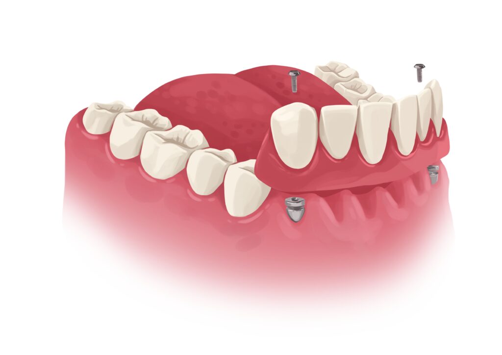 implant-bridge-for-front-lower-teeth-technical-picture_50730895336_o
