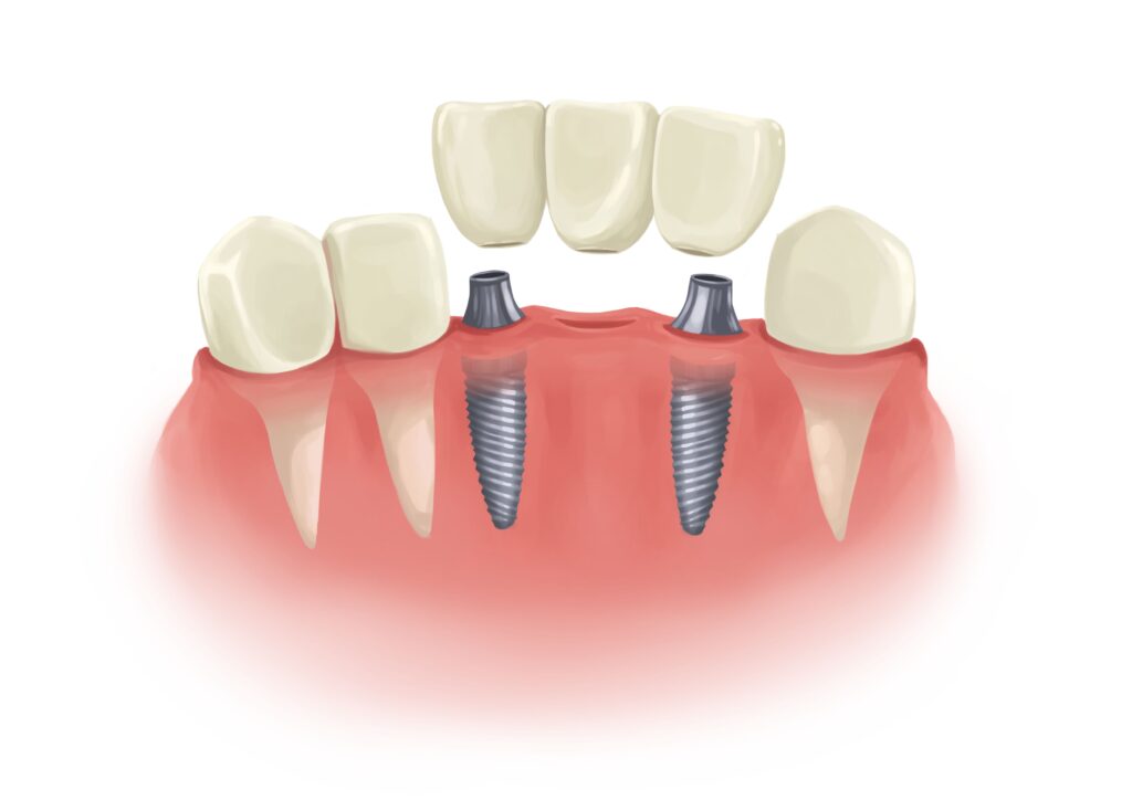 implant-bridge-in-parts-next-to-natural-teeth-technical-picture_50730991252_o