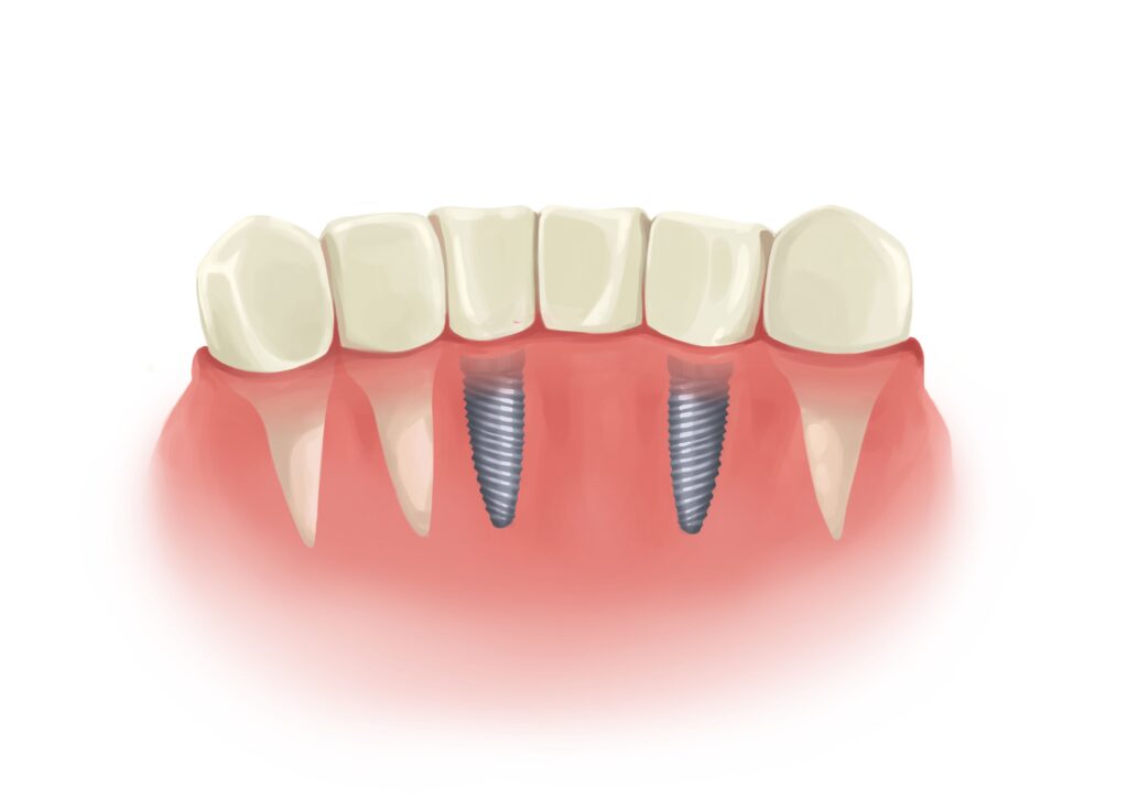 implant-bridge-next-to-natural-teeth-technical-picture_50730895311_o