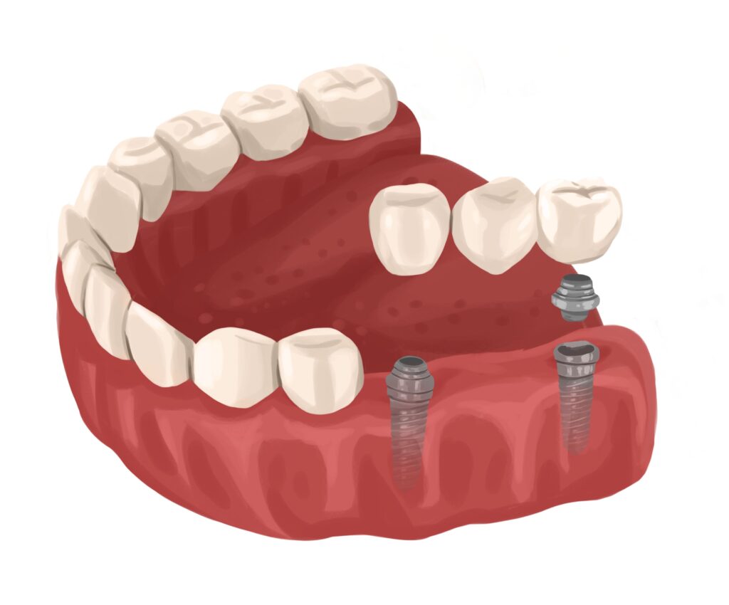 implant-dental-bridge-technical-picture_51261151791_o