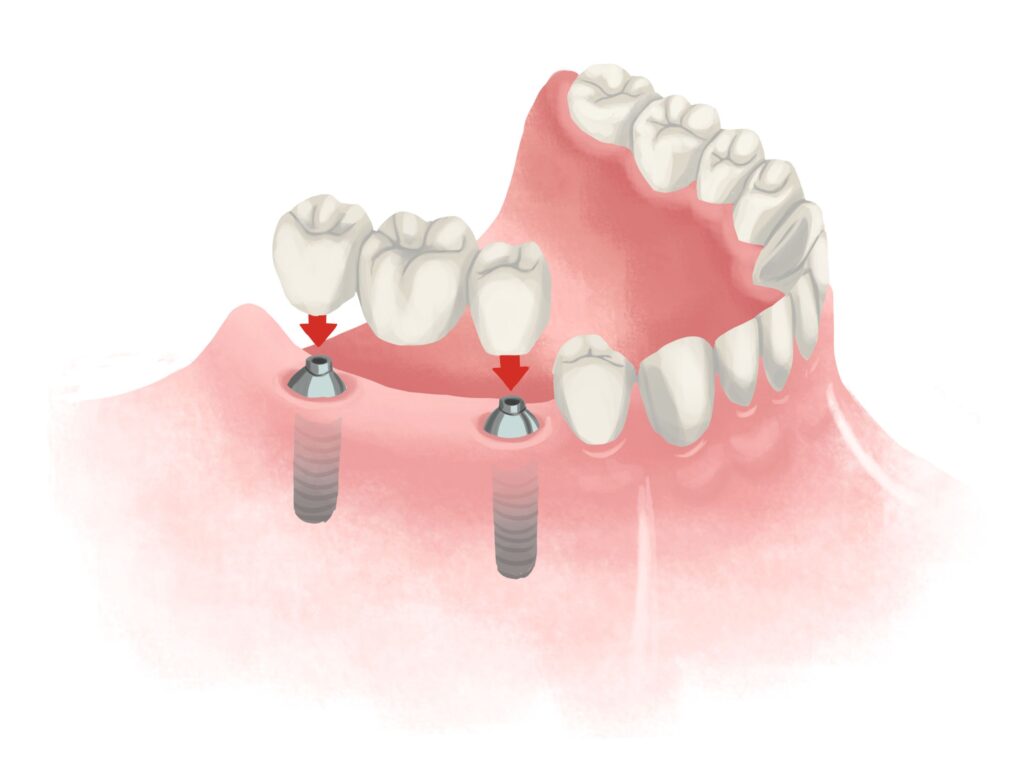 implant-supported-bridge-on-lower-arch-technical-picture_50730991397_o