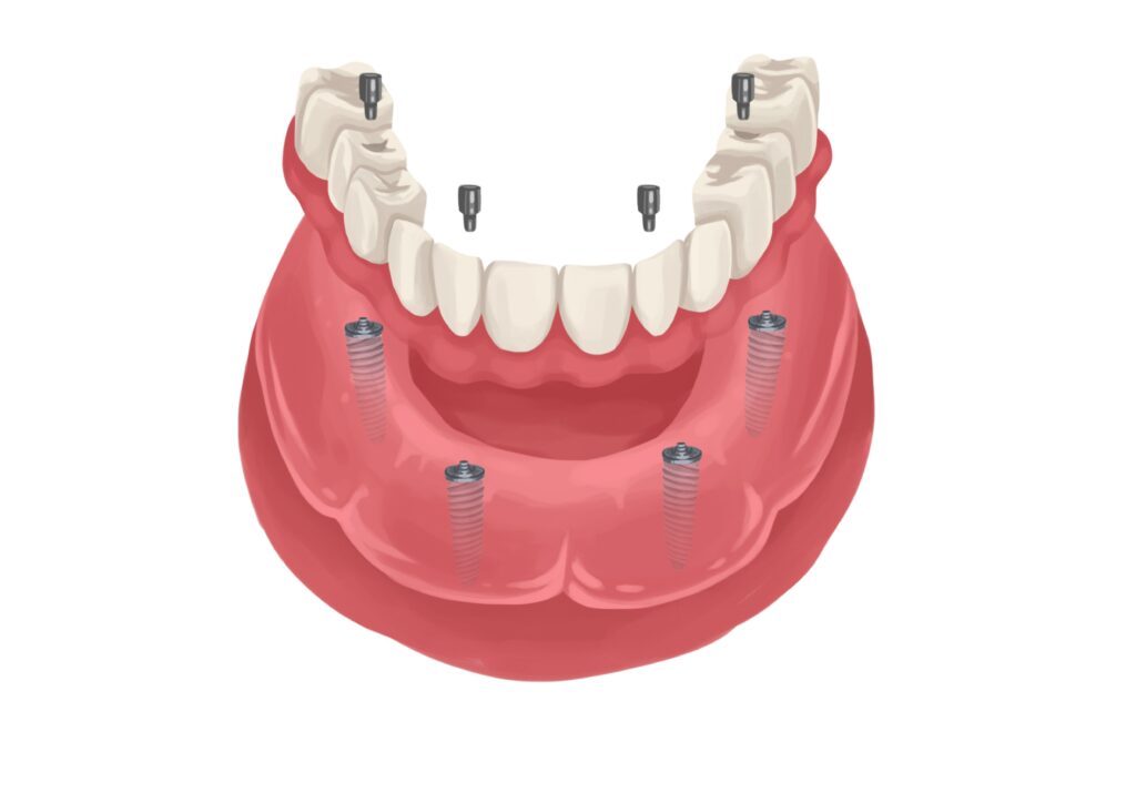 implant-supported-denture-lower-arch-technical-picture_50730895136_o