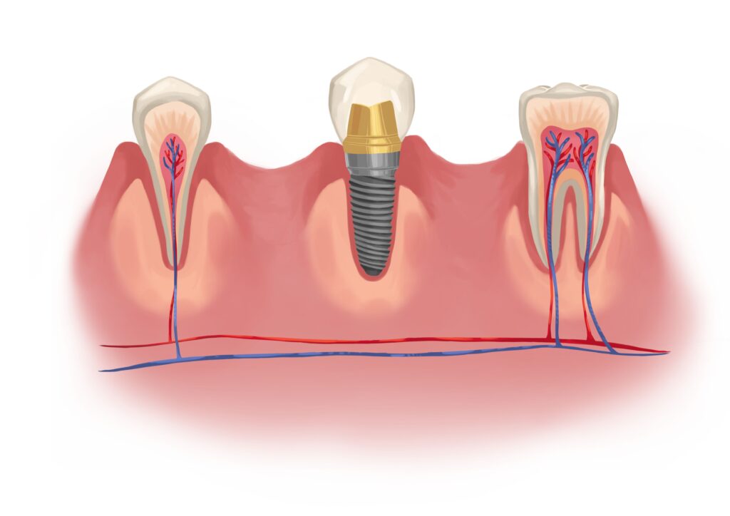 implant-vs-teeth-inside-technical-picture_50730895421_o