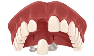 maryland-dental-bridge-technical-picture_51261898049_o