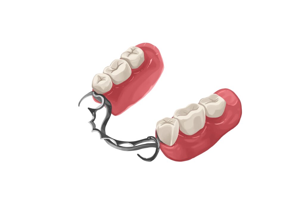 metal-partial-denture-for-lower-arch-technical-picture_50729828487_o