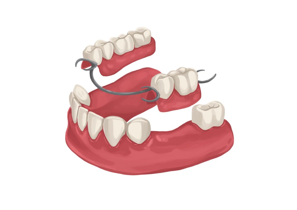 metal-partial-dentures-for-lower-arch-technical-picture_50729002598_o