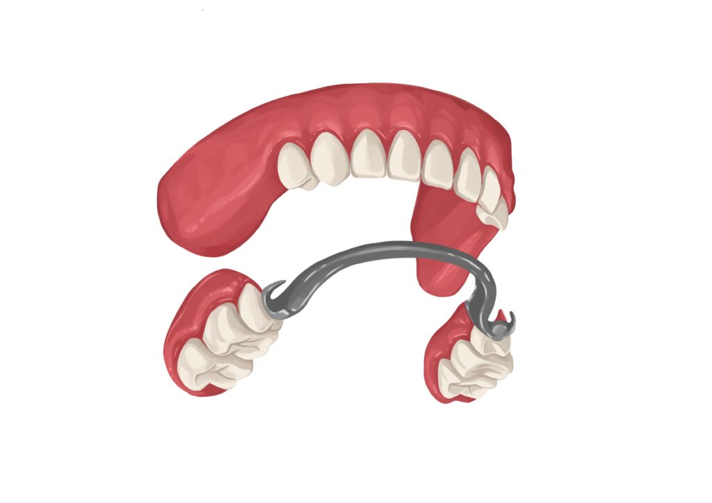 metal-partial-dentures-for-upper-arch-technical-picture_50729002528_o