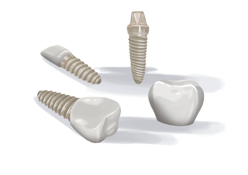 mix-of-zirconia-dental-implants-technical-picture_50730894986_o