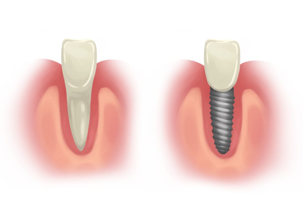 natural-tooth-vs-dental-implant-technical-picture_50730894806_o