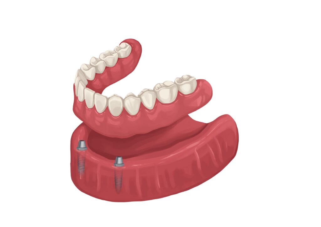 removable-implants-denture-technical-picture_50730166313_o