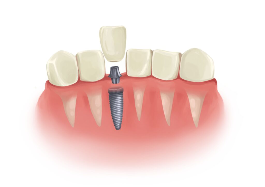 single-dental-implant-in-parts-next-to-natural-teeth-technical-picture_50730895261_o