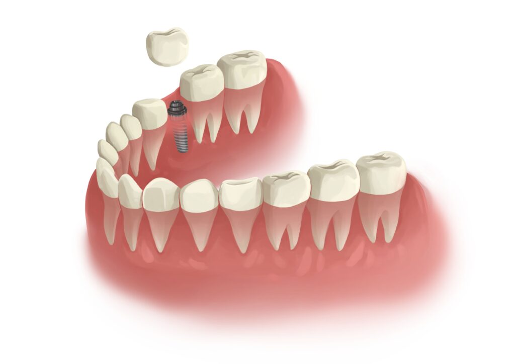 single-dental-implant-lower-arch-technical-picture_50730990817_o