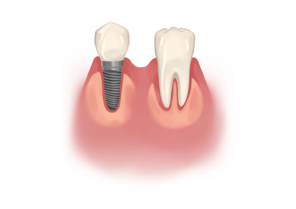 single-dental-implant-next-to-natural-back-tooth-technical-picture_50730166353_o