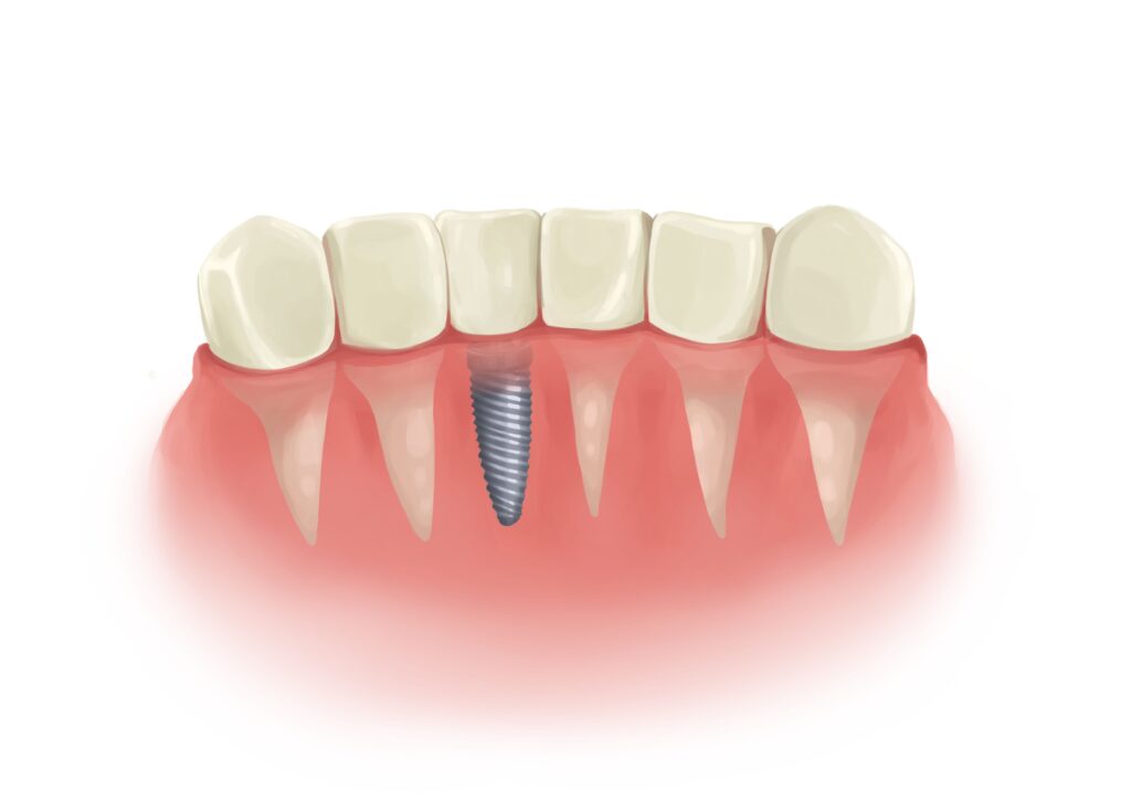 single-dental-implant-next-to-natural-teeth-technical-picture_50730895096_o