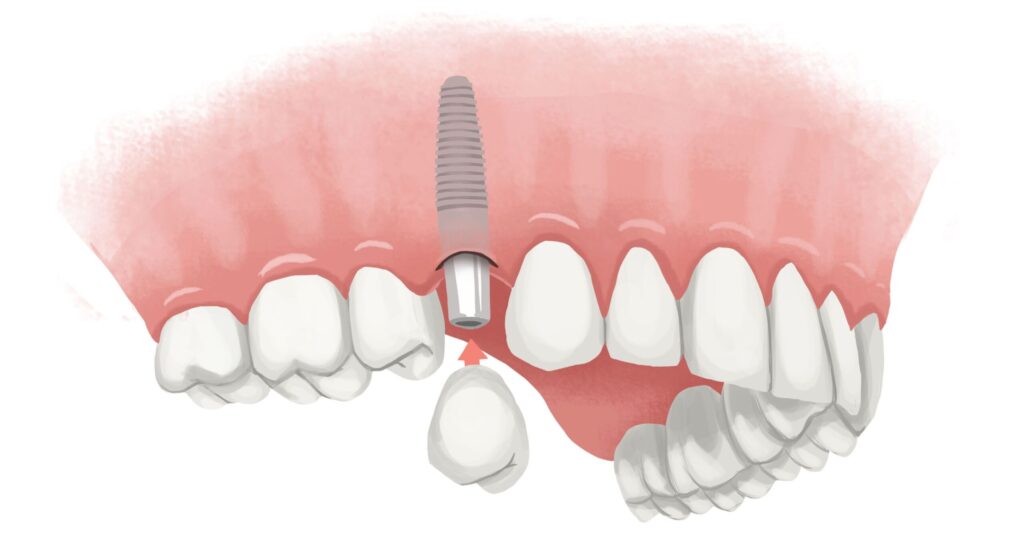 single-tooth-implant-upper-arch-technical-picture_50730895456_o