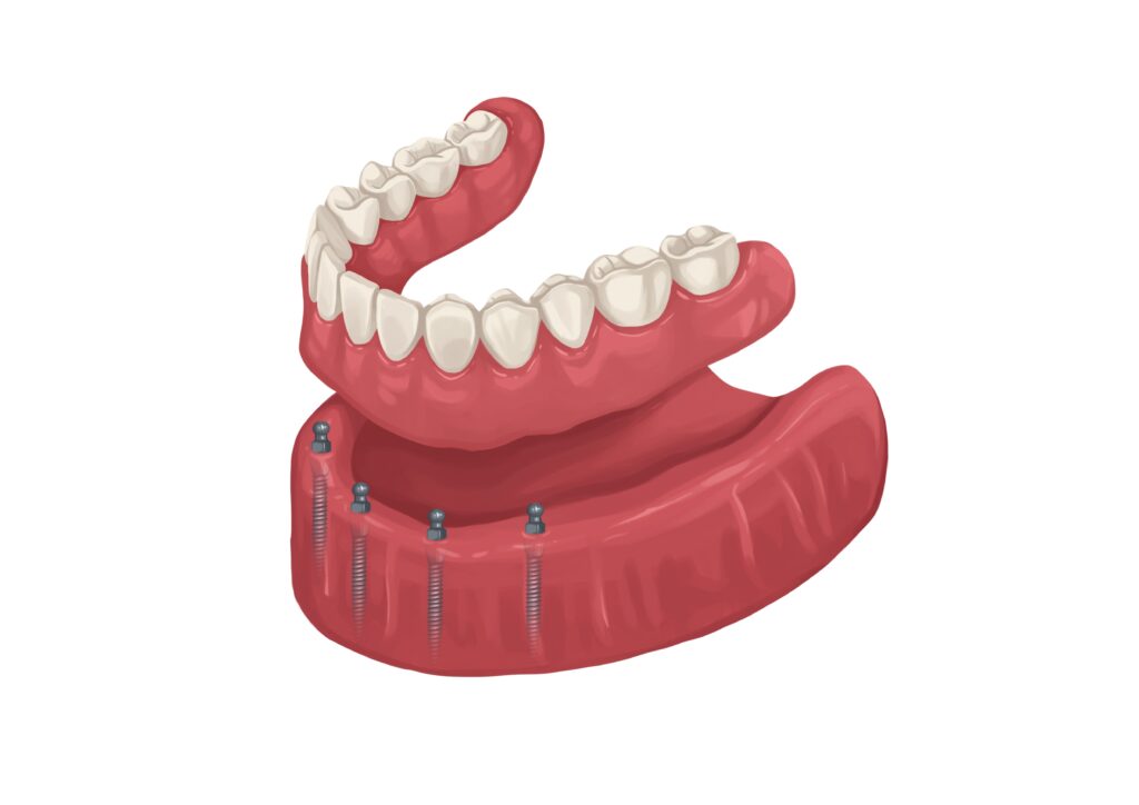 snap-in-denture-on-mini-dental-implants-technical-picture_50730895016_o