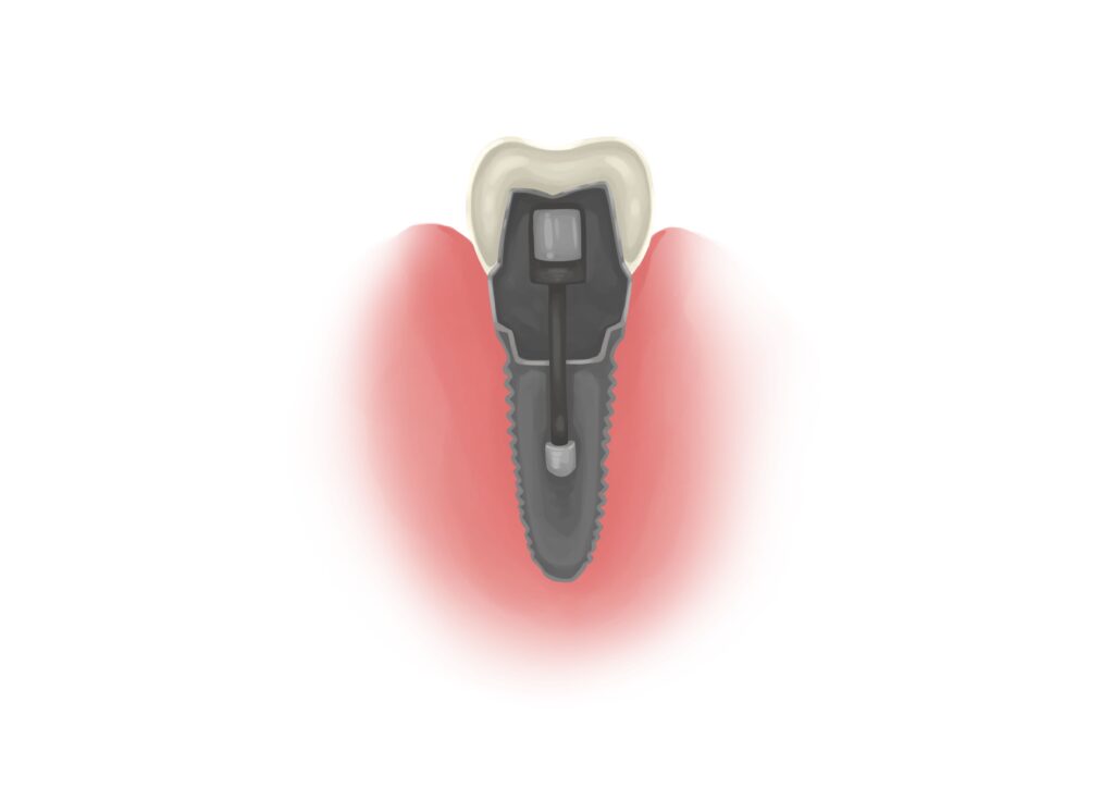 the-inside-of-the-implant-technical-picture_50730166243_o