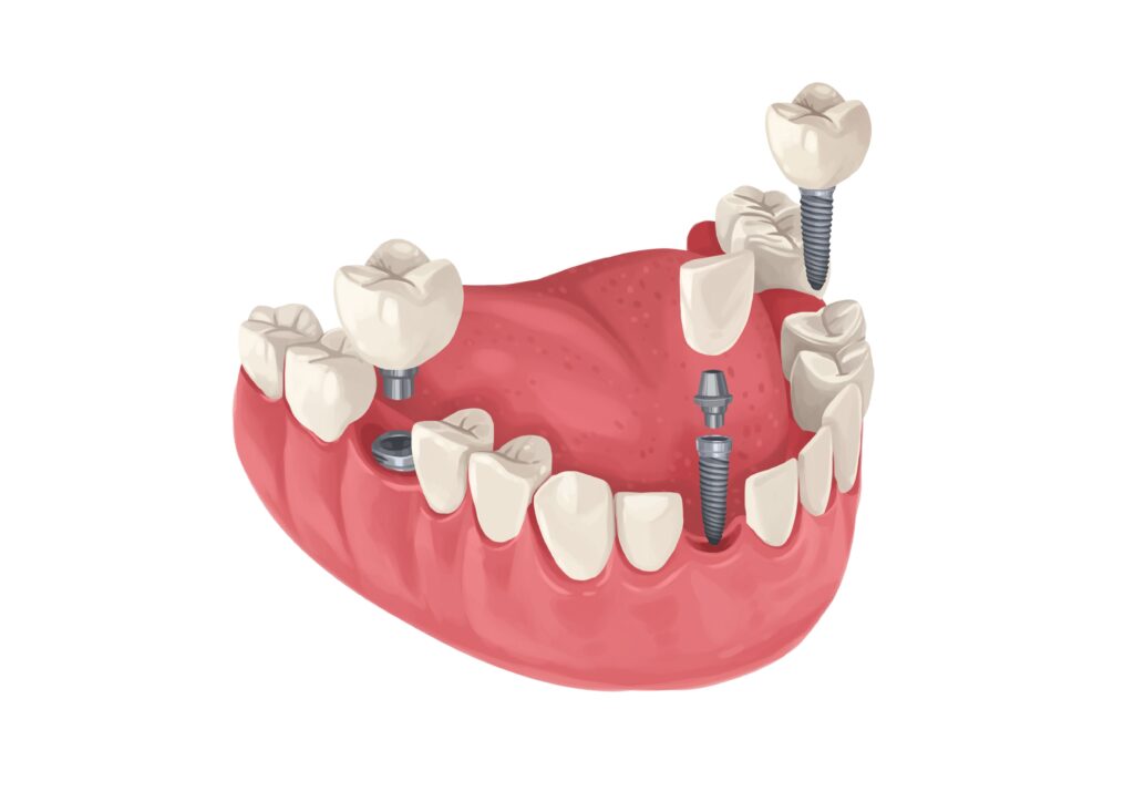 three-single-implants-in-parts-lower-arch-technical-picture_50730166083_o