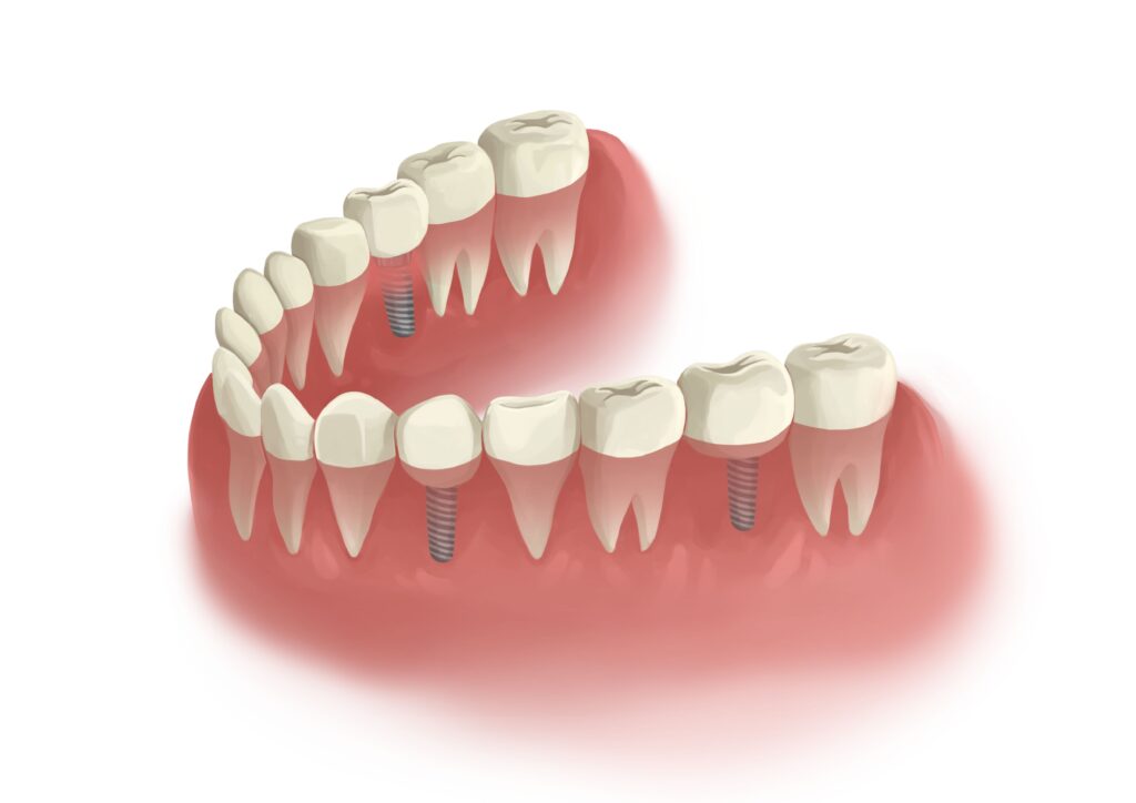 three-single-implants-lower-arch--technical-picture_50730990622_o