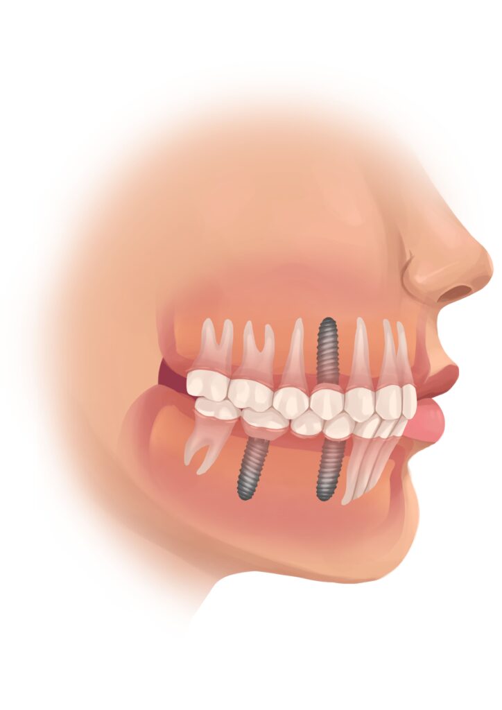 titanium-dental-implants-face-profile-technical-picture_50730990757_o