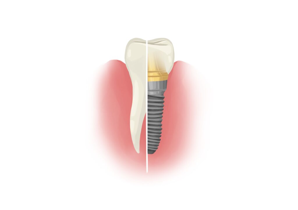 tooth-and-implant-half-by-half-technical-picture_50730166113_o