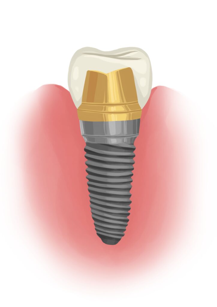 tooth-implant-in-the-gum-technical-picture_50730895436_o