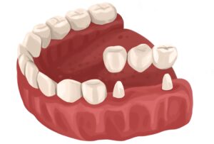 traditional-dental-bridge-technical-picture_51261898039_o