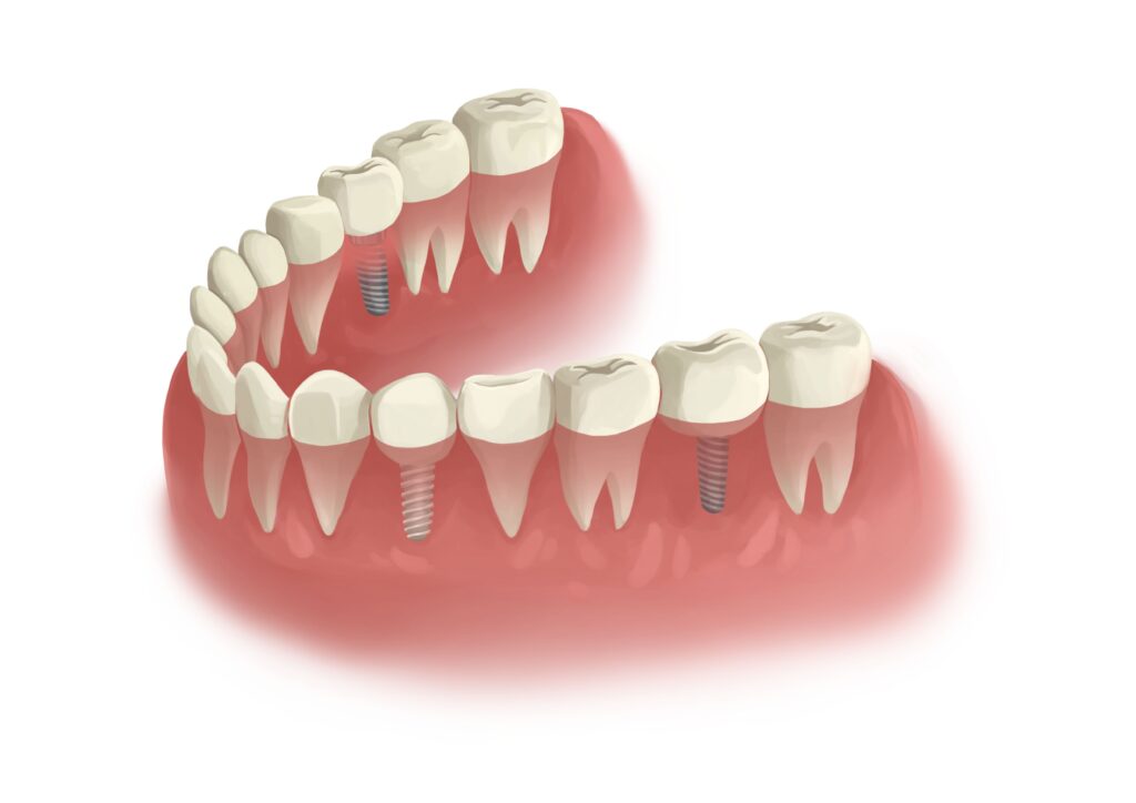 zirconia-and-titanium-implants-in-lower-arch-technical-picture_50730990562_o